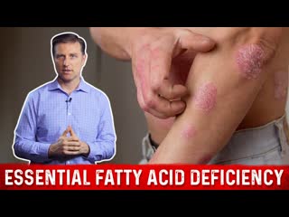 Fatty Acids (Omega-3 and Omega-6) Deficiency: Symptoms and Sources by