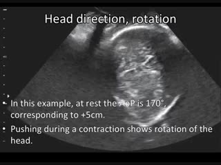ISUOG practice guideline on intrapartum ultrasound