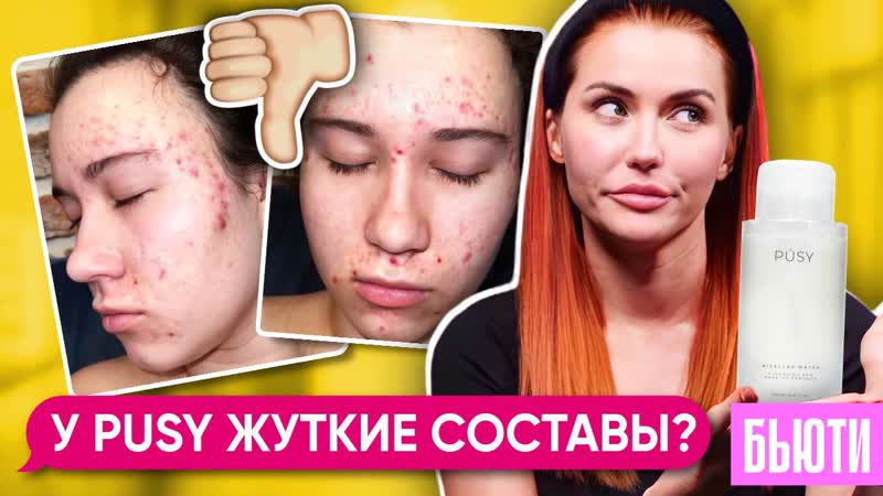 МИЦЕЛЯРКА ОТ PUSY УБИЛА МОЕ ЛИЦО , Жуткое акне после
