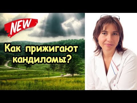 Как прижигают кондиломы на