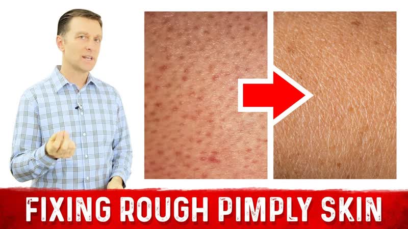 What Does Rough Pimply Skin ( Chicken Skin or KERATOSIS PILARIS) Mean Dr.